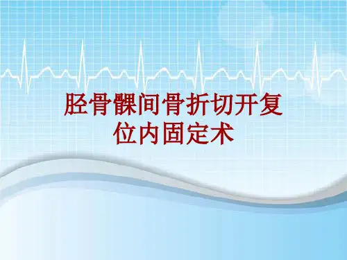 手术讲解模板：胫骨髁间骨折切开复位内固定术
