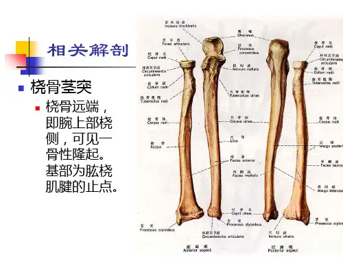 桡骨茎突部狭窄性腱鞘炎ppt课件