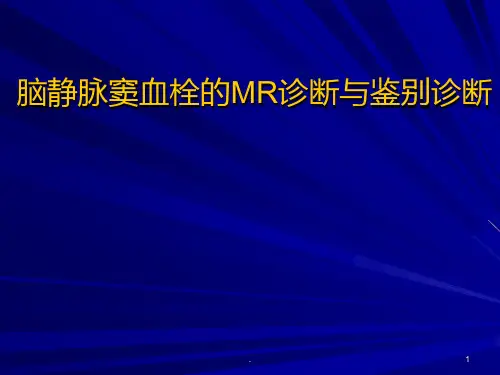 脑静脉窦血栓的MR诊断与鉴别诊断