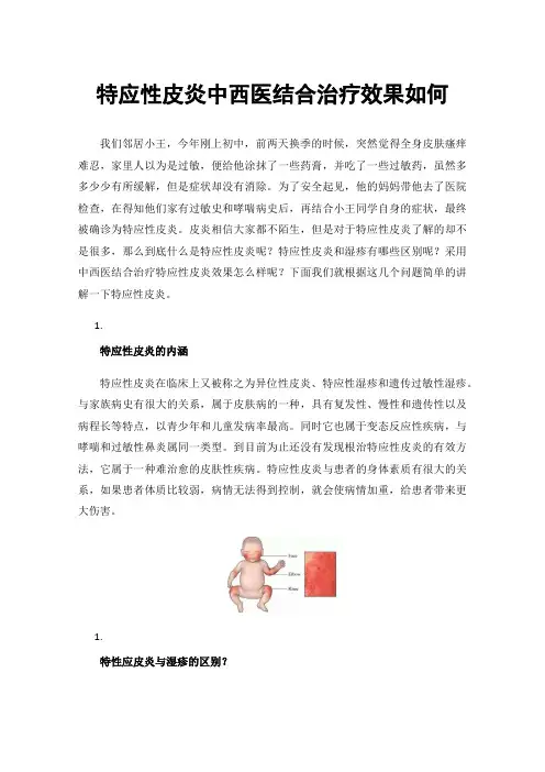 特应性皮炎中西医结合治疗效果如何