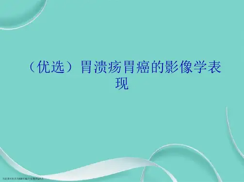 胃溃疡胃癌的影像学表现演示
