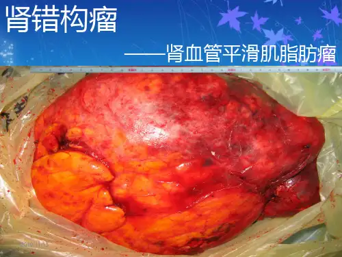 肾错构瘤PPT课件