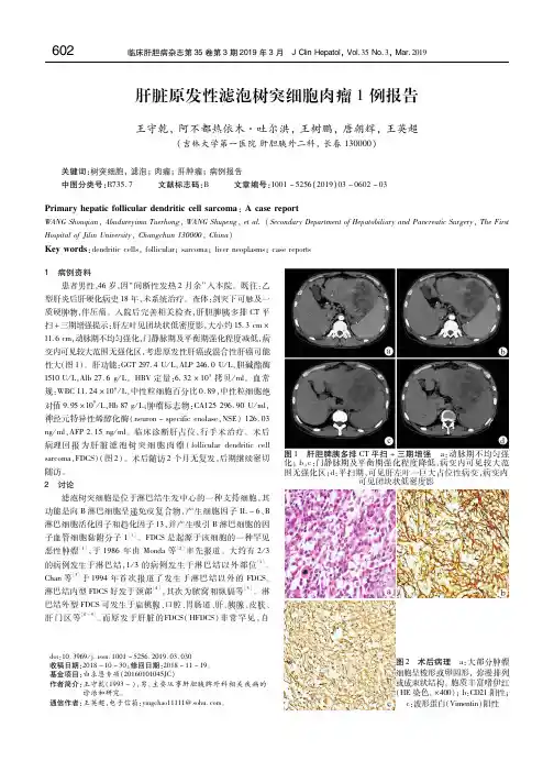 肝脏原发性滤泡树突细胞肉瘤1例报告 王守乾