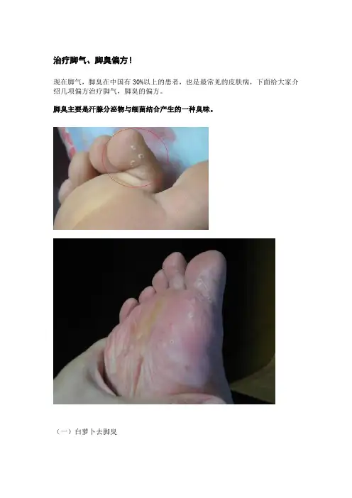 治疗脚气的小偏方