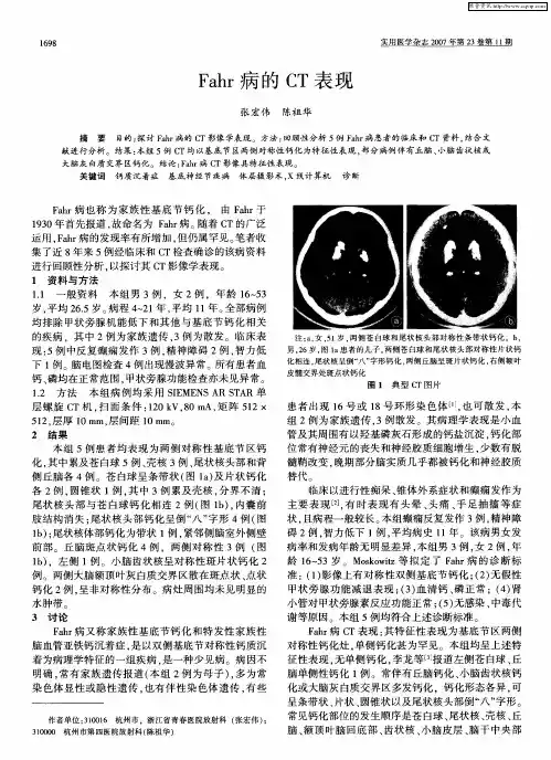 Fahr病的CT表现