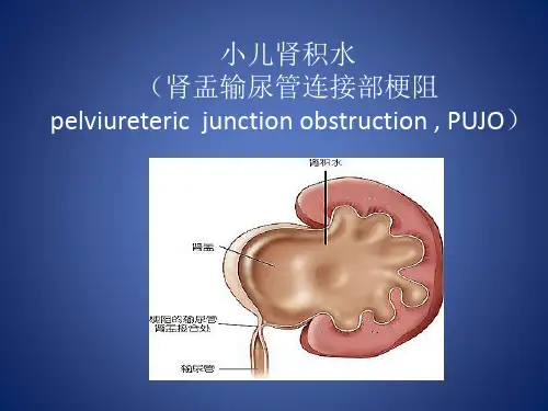 小儿肾积水