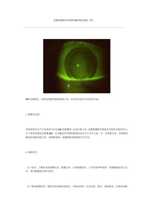 RGP镜的验配