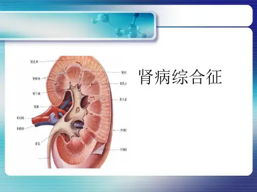 肾病综合征