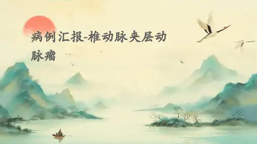 病例汇报-椎动脉夹层动脉瘤
