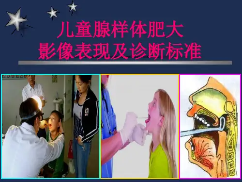 儿童腺样体肥大影像表现及诊断标准