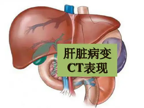 《CT肝脏病变》PPT课件