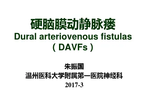 硬脑膜动静脉瘘(2017最新PPT)