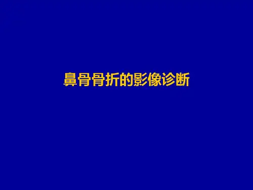 鼻骨骨折的影像诊断参考PPT