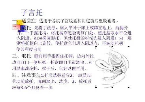 子宫脱垂课件3