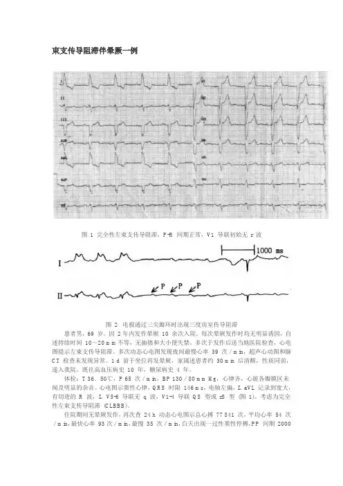 束支传导阻滞伴晕厥一例