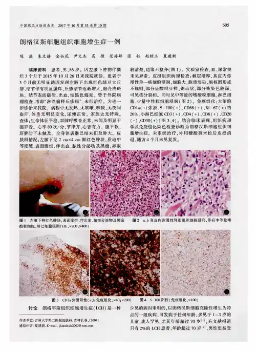 朗格汉斯细胞组织细胞增生症一例