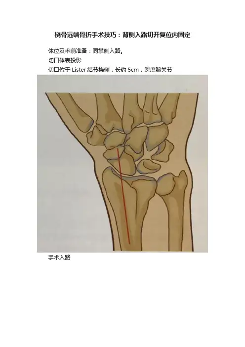 桡骨远端骨折手术技巧：背侧入路切开复位内固定