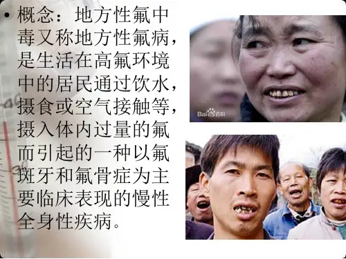 地方性氟中毒 ppt课件