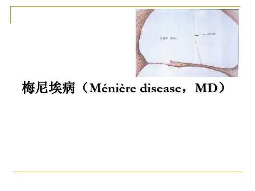 医学课件：梅尼埃病