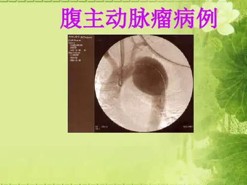 腹主动脉瘤内科治疗成功病案一例