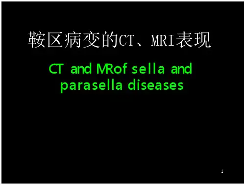 鞍区解剖-断层的影像解剖