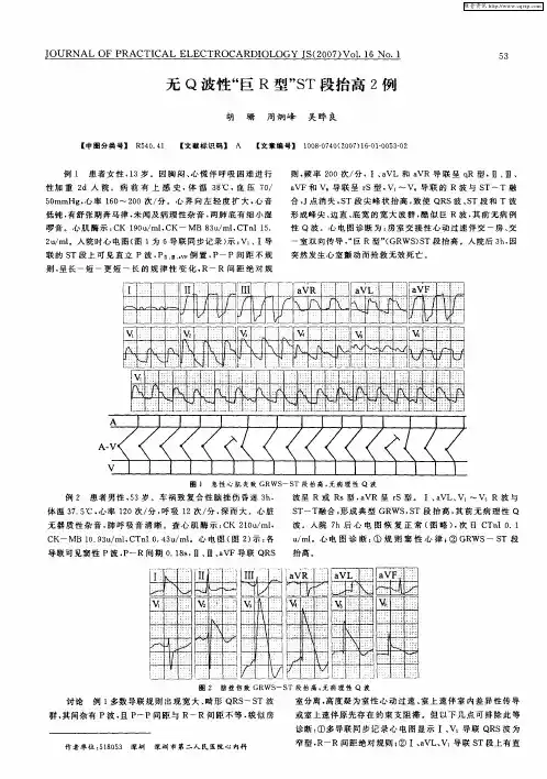 无Q波性“巨R型”ST段抬高2例