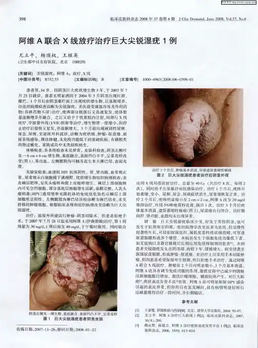 阿维A联合X线放疗治疗巨大尖锐湿疣1例
