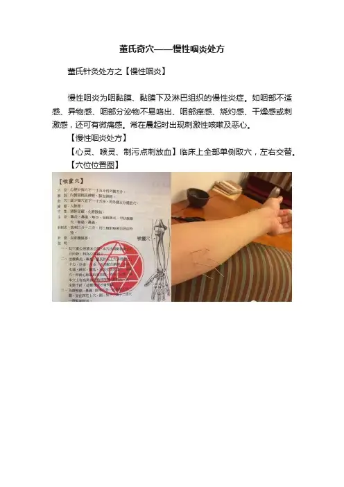 董氏奇穴——慢性咽炎处方