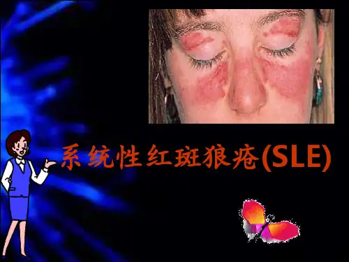系统性红斑狼疮(SLE)PPT课件