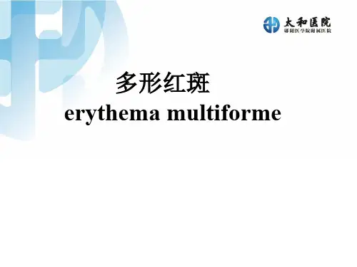 【皮肤性病学】多形红斑PPT课件