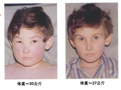肾病综合征