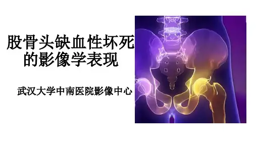 (2.3.1)--股骨头坏死的影像学诊断