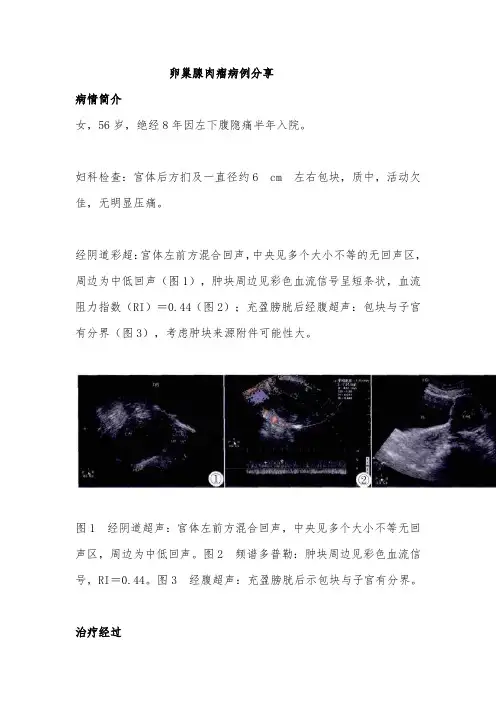 卵巢腺肉瘤病例分享