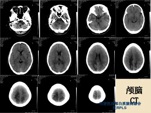 可逆性后部白质脑病综合征RPLS