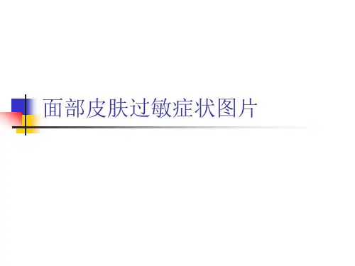 面部皮肤过敏症状图片PPT课件