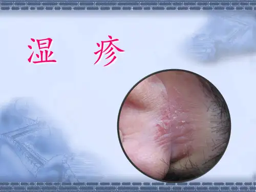 中医治疗湿疹ppt课件