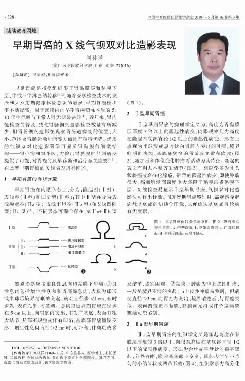 早期胃癌的X线气钡双对比造影表现