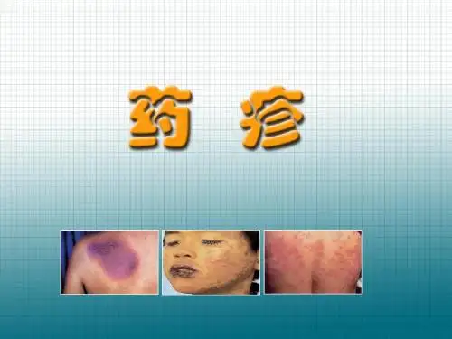 药疹4