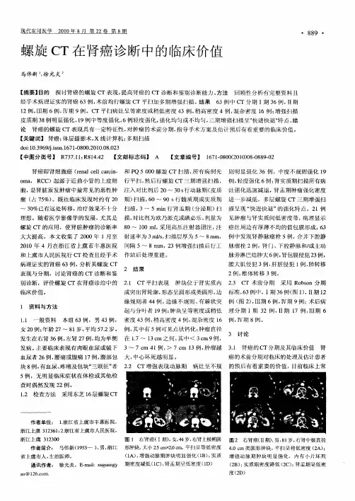 螺旋CT在肾癌诊断中的临床价值