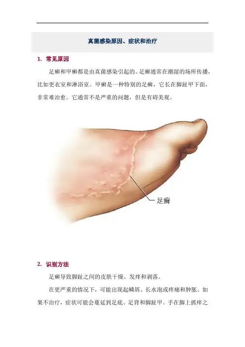 真菌感染原因、症状和治疗
