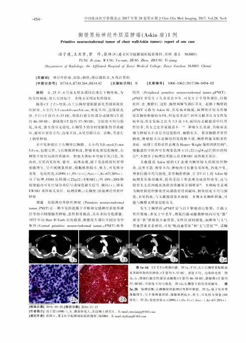 胸壁原始神经外胚层肿瘤(Askin瘤)1例