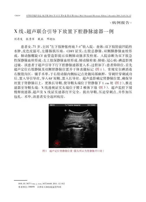 X线、超声联合引导下放置下腔静脉滤器一例