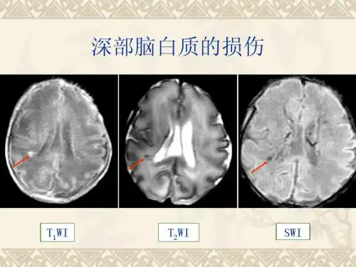 新生儿缺氧缺血或窒息所致脑损伤的影像学诊断