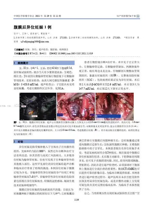 腹膜后异位妊娠1例