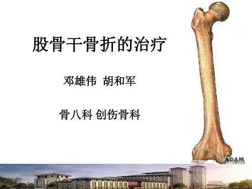 股骨干骨折骨折ppt课件
