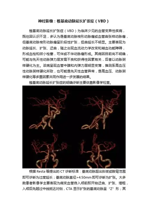 神经影像：椎基底动脉延长扩张症（VBD）