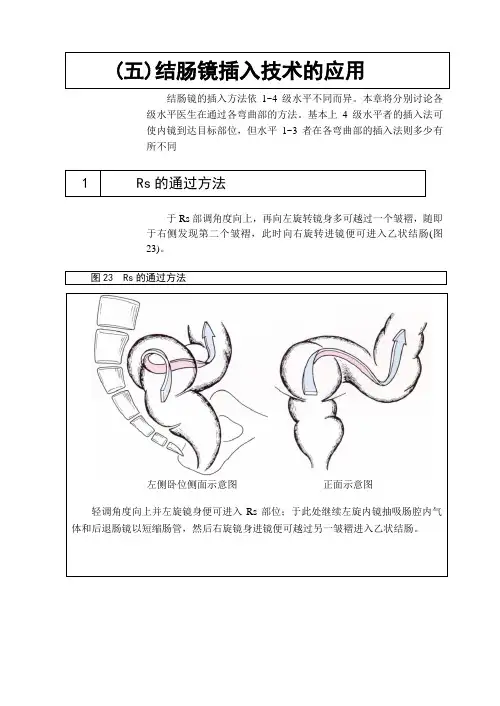 第五章 结肠镜插入技术的应用