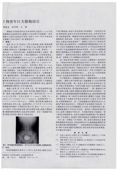 2例青年巨大膀胱结石