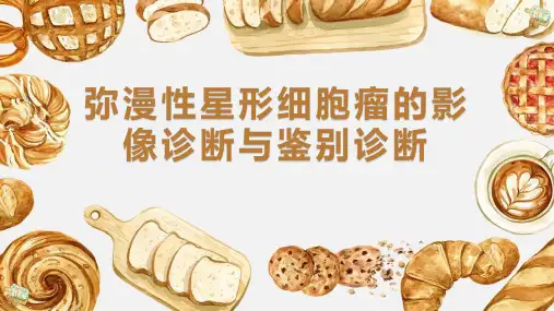 弥漫性星形细胞瘤的影像诊断与鉴别诊断