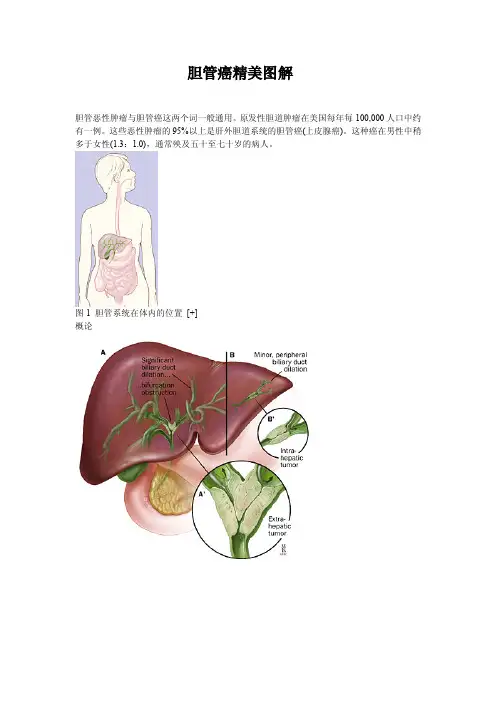 胆管癌精美图解